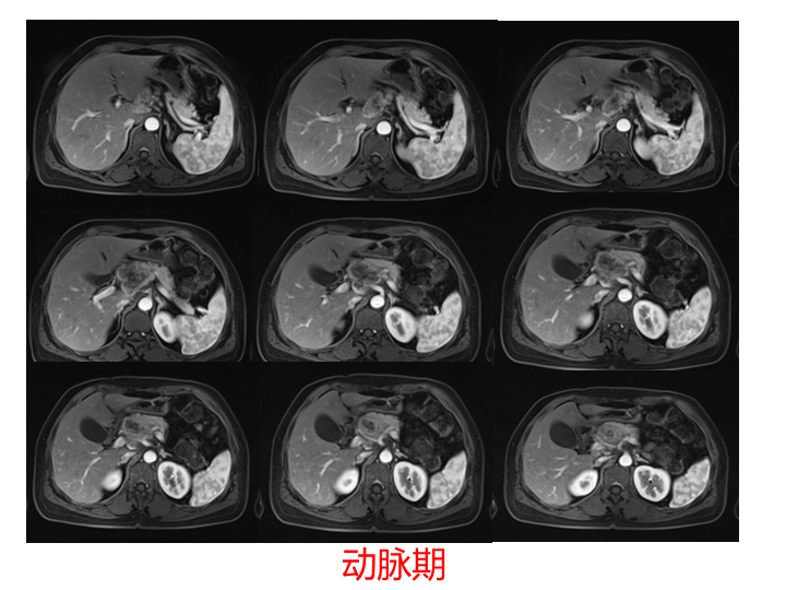 影像PPT - 【病例】胰腺腺泡细胞癌2例CT影像-15
