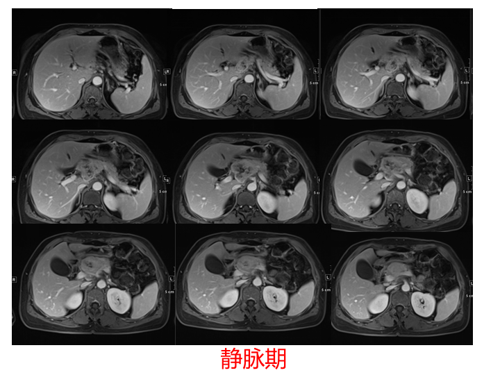 影像PPT - 【病例】胰腺腺泡细胞癌2例CT影像-16