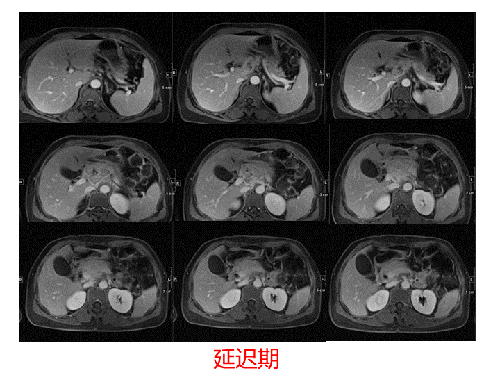 影像PPT - 【病例】胰腺腺泡细胞癌2例CT影像-17