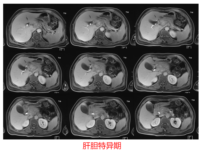 影像PPT - 【病例】胰腺腺泡细胞癌2例CT影像-18