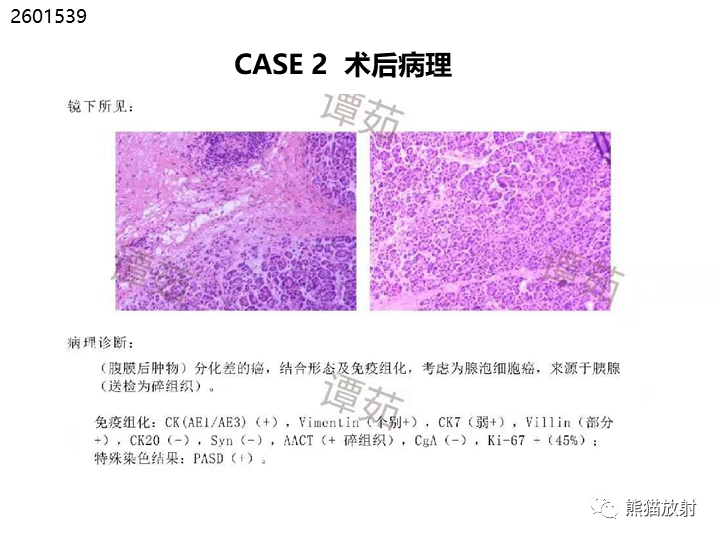 影像PPT - 【病例】胰腺腺泡细胞癌2例CT影像-24