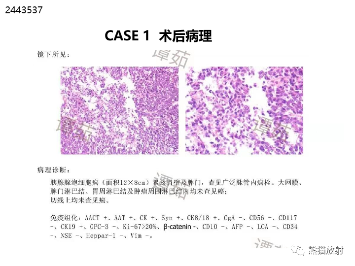 影像PPT - 【病例】胰腺腺泡细胞癌2例CT影像-23