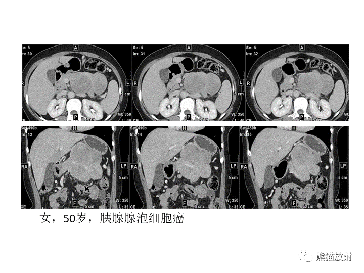 影像PPT - 【病例】胰腺腺泡细胞癌2例CT影像-33