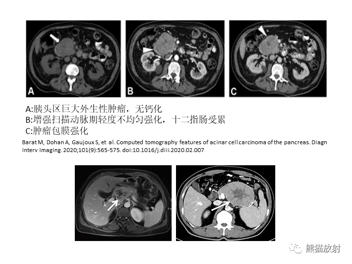 影像PPT - 【病例】胰腺腺泡细胞癌2例CT影像-32