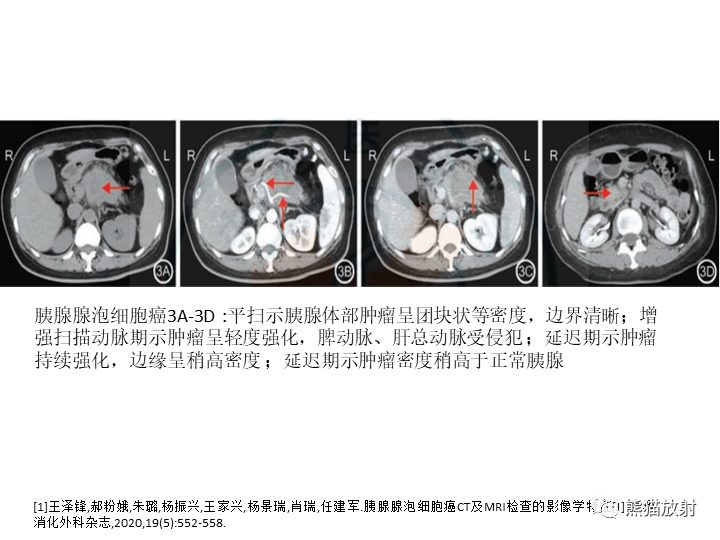 影像PPT - 【病例】胰腺腺泡细胞癌2例CT影像-34
