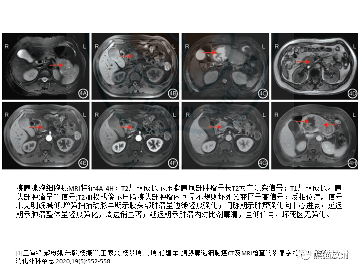 影像PPT - 【病例】胰腺腺泡细胞癌2例CT影像-35