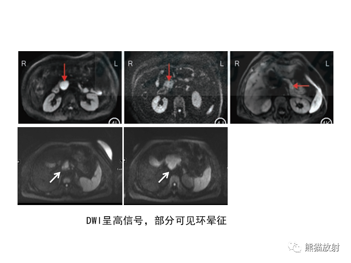 影像PPT - 【病例】胰腺腺泡细胞癌2例CT影像-36
