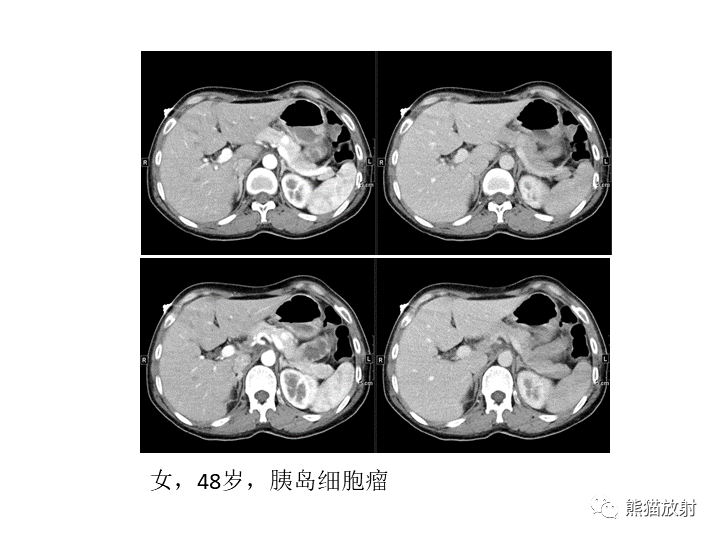 影像PPT - 【病例】胰腺腺泡细胞癌2例CT影像-40