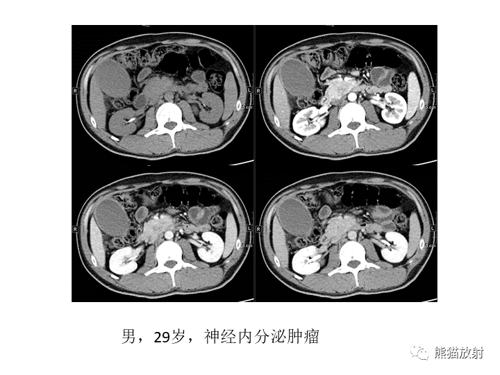影像PPT - 【病例】胰腺腺泡细胞癌2例CT影像-41