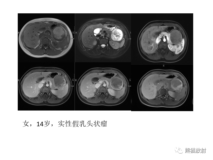 影像PPT - 【病例】胰腺腺泡细胞癌2例CT影像-43