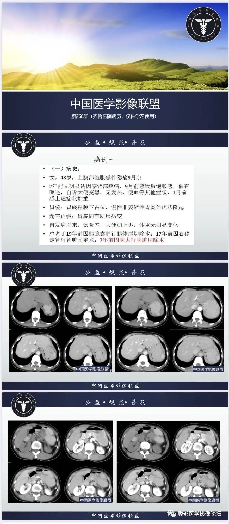 影像PPT - 【病例】胃异位脾种植2例CT-1