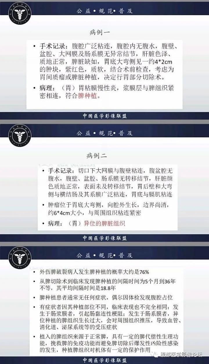 影像PPT - 【病例】胃异位脾种植2例CT-3