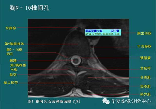影像PPT - 史上最全断层解剖图谱-38