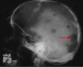 影像PPT - 9种边界不清的溶骨性肿瘤和肿瘤样病变-17 影像PPT - 9种边界不清的溶骨性肿瘤和肿瘤样病变-17