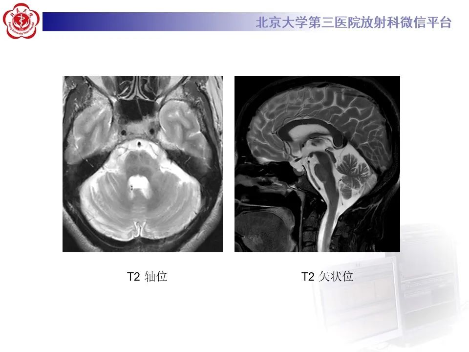 影像PPT - 【PPT】橄榄桥脑小脑萎缩影像诊断-3