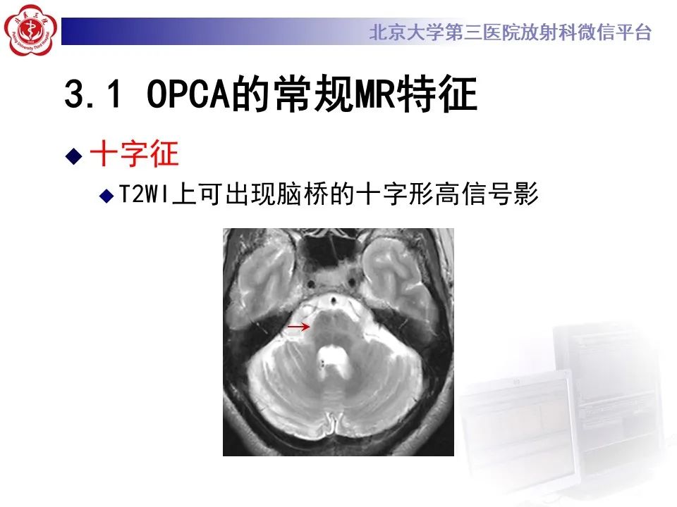 影像PPT - 【PPT】橄榄桥脑小脑萎缩影像诊断-20