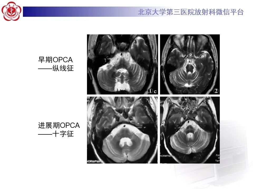影像PPT - 【PPT】橄榄桥脑小脑萎缩影像诊断-23