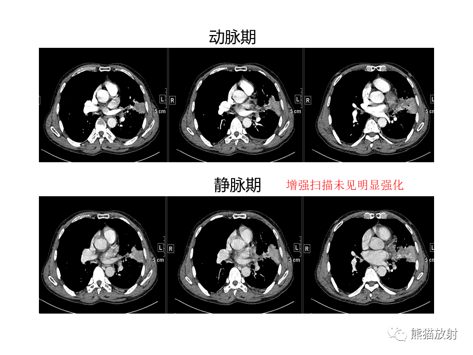 影像PPT - 【病例】肺淀粉样变性2例CT影像-6