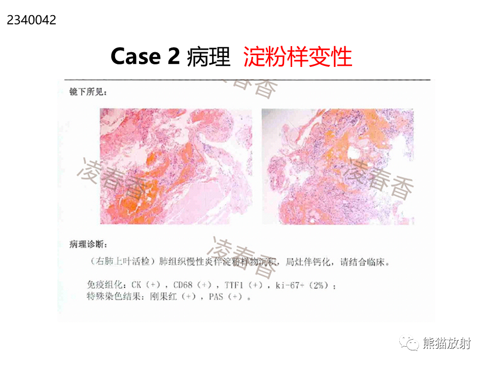 影像PPT - 【病例】肺淀粉样变性2例CT影像-16
