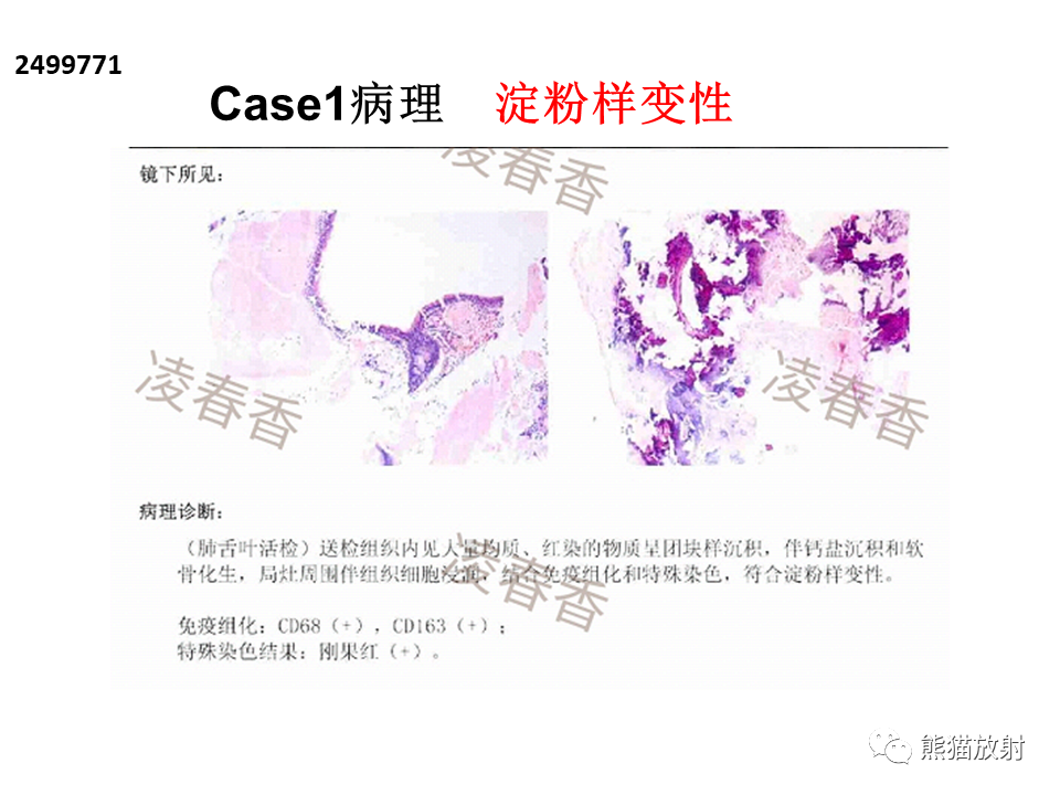 影像PPT - 【病例】肺淀粉样变性2例CT影像-15