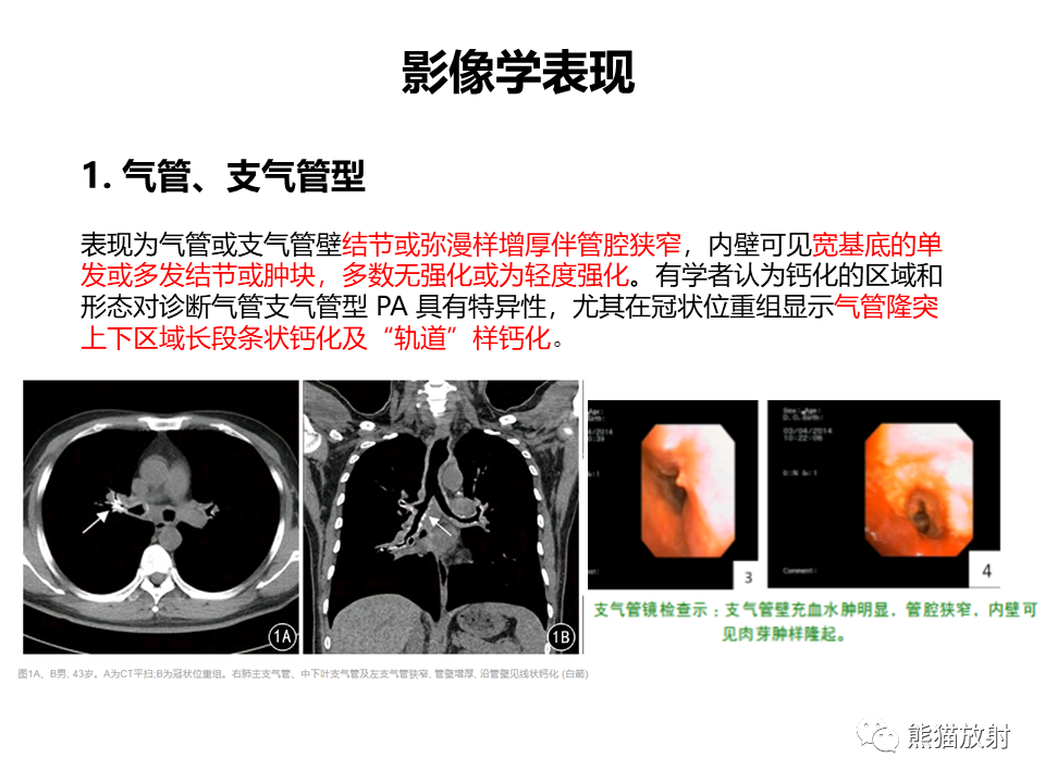 影像PPT - 【病例】肺淀粉样变性2例CT影像-20
