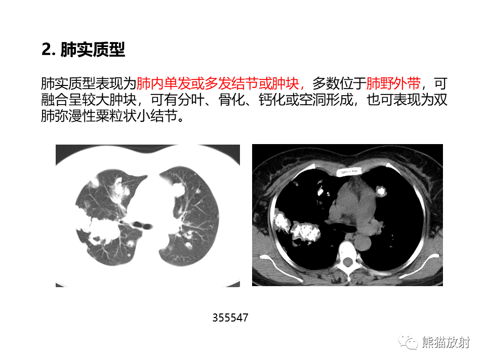 影像PPT - 【病例】肺淀粉样变性2例CT影像-21
