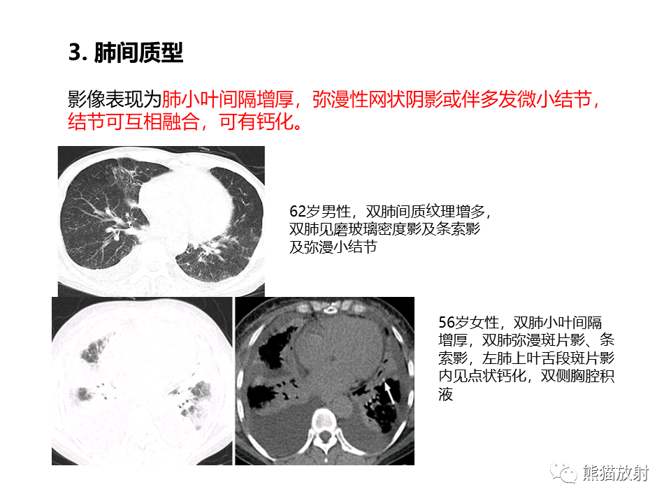 影像PPT - 【病例】肺淀粉样变性2例CT影像-22