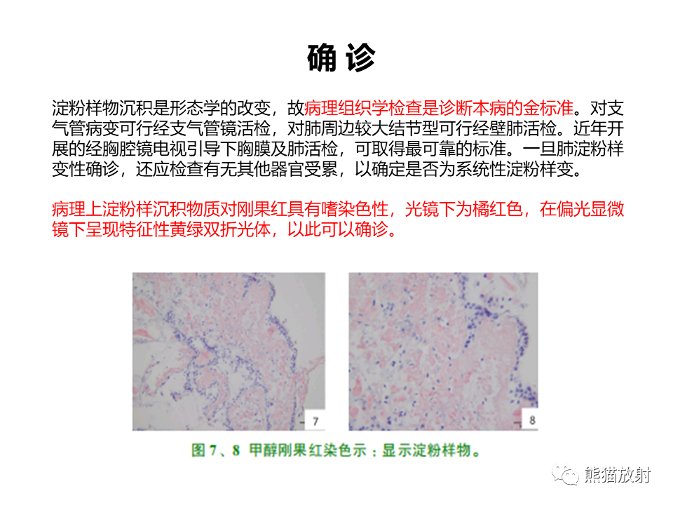 影像PPT - 【病例】肺淀粉样变性2例CT影像-23