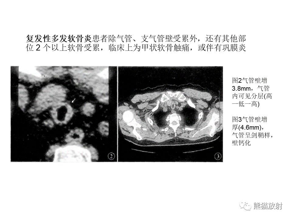 影像PPT - 【病例】肺淀粉样变性2例CT影像-25