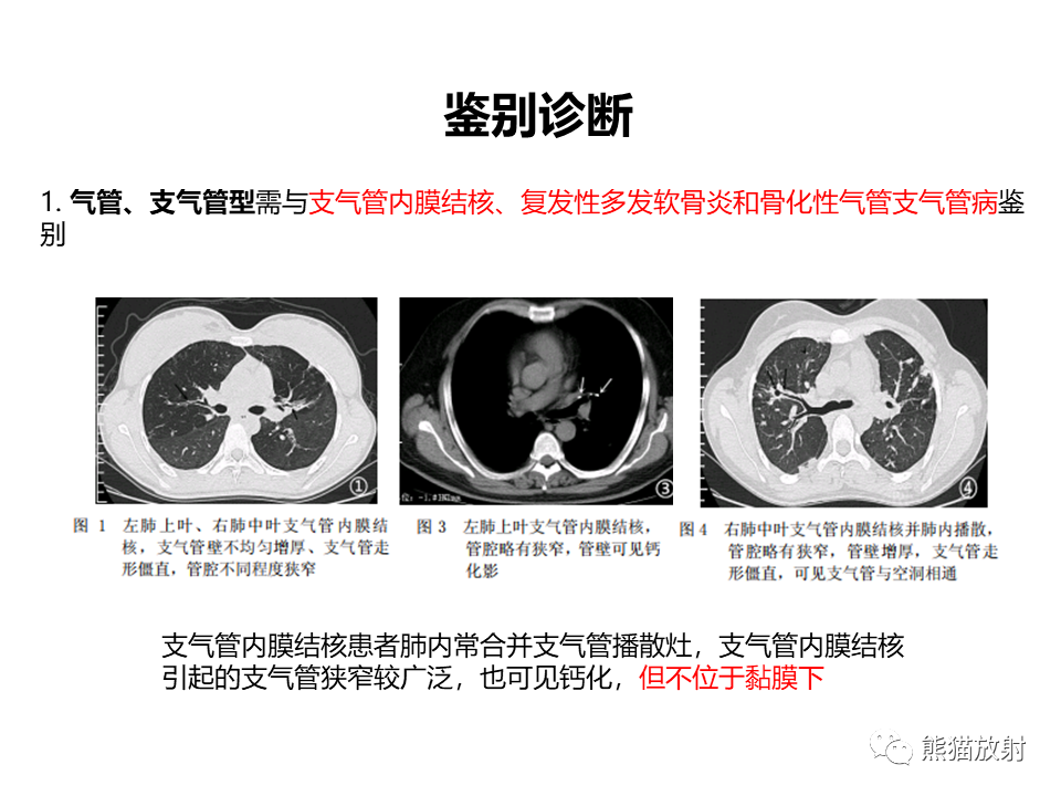 影像PPT - 【病例】肺淀粉样变性2例CT影像-24