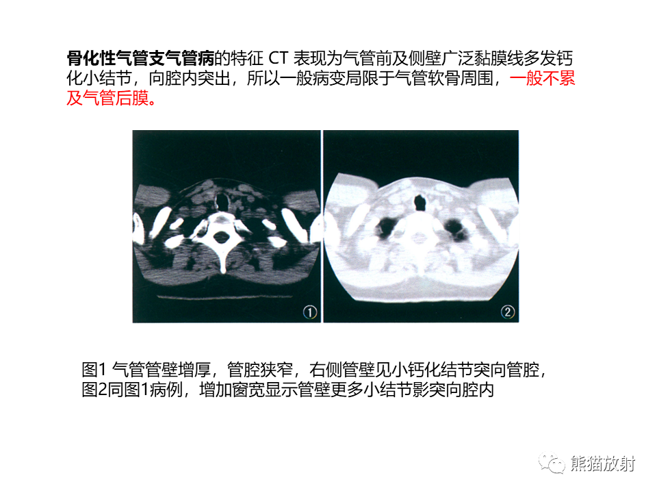 影像PPT - 【病例】肺淀粉样变性2例CT影像-26