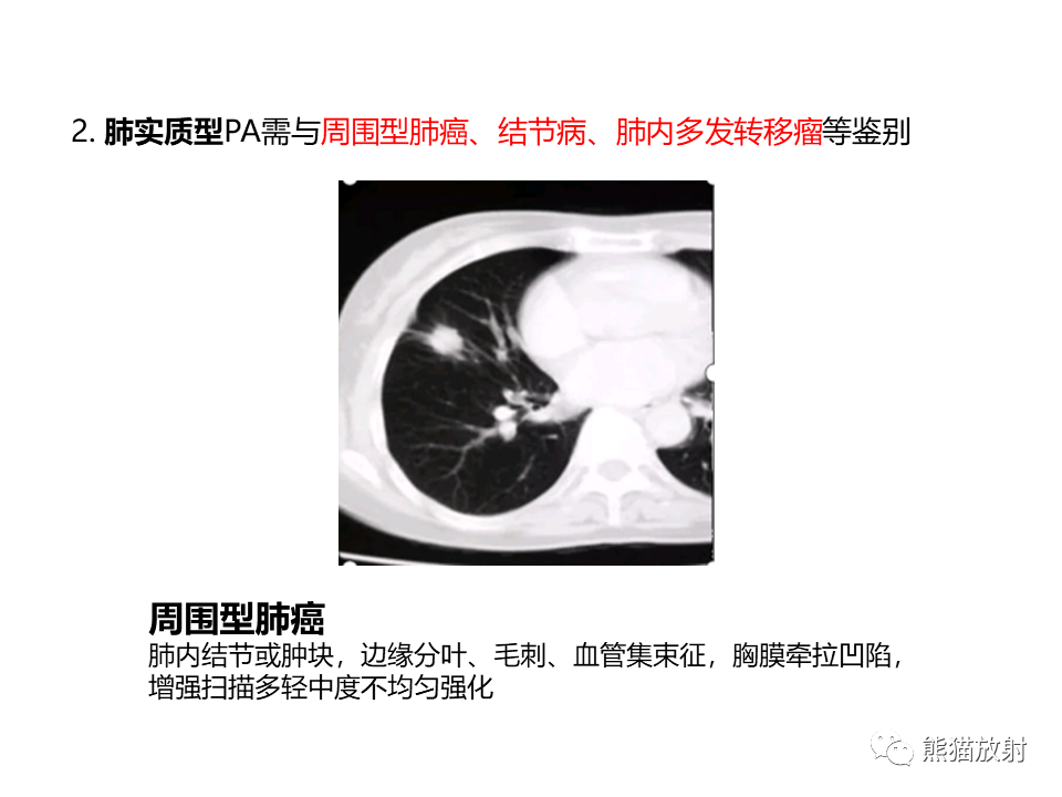 影像PPT - 【病例】肺淀粉样变性2例CT影像-27