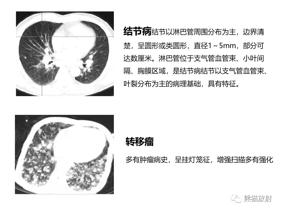 影像PPT - 【病例】肺淀粉样变性2例CT影像-28