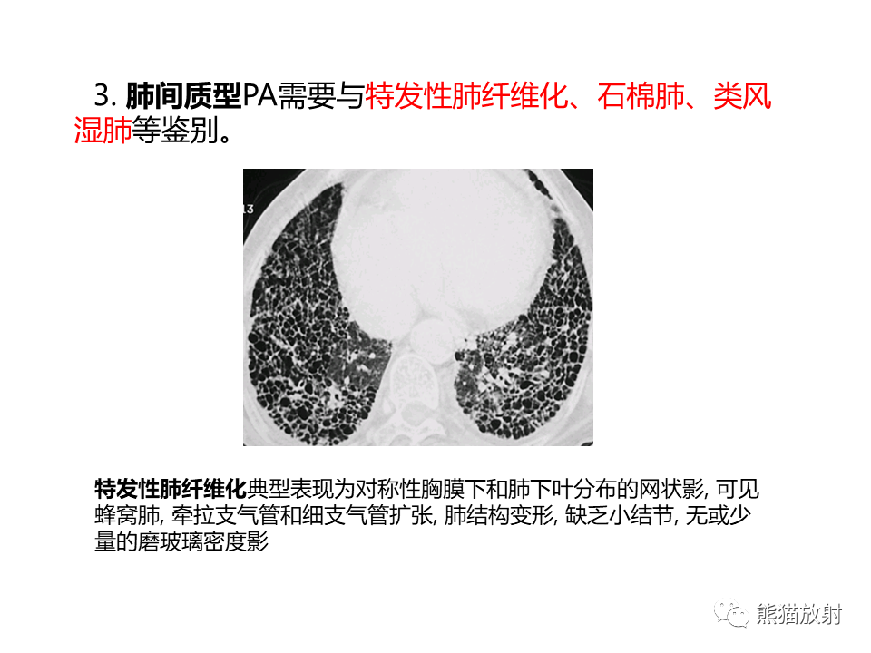 影像PPT - 【病例】肺淀粉样变性2例CT影像-29