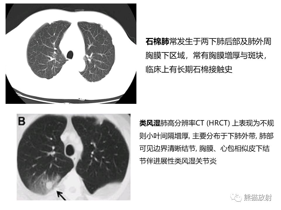 影像PPT - 【病例】肺淀粉样变性2例CT影像-30