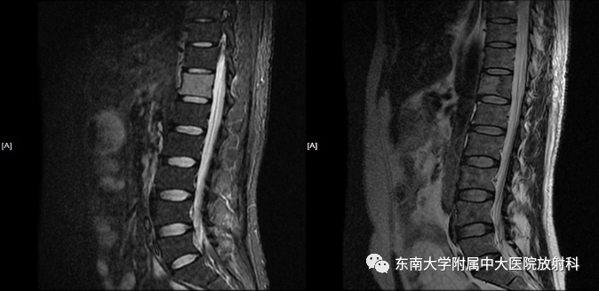 影像PPT - 【病例】脊柱朗格汉斯组织细胞增生症1例CT-1