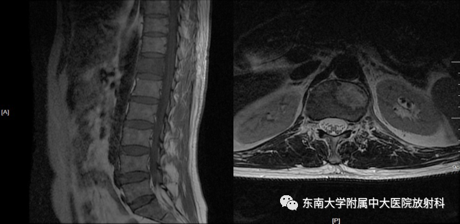 影像PPT - 【病例】脊柱朗格汉斯组织细胞增生症1例CT-2