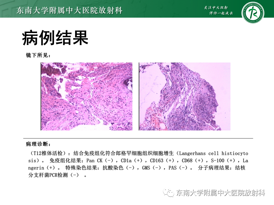 影像PPT - 【病例】脊柱朗格汉斯组织细胞增生症1例CT-3