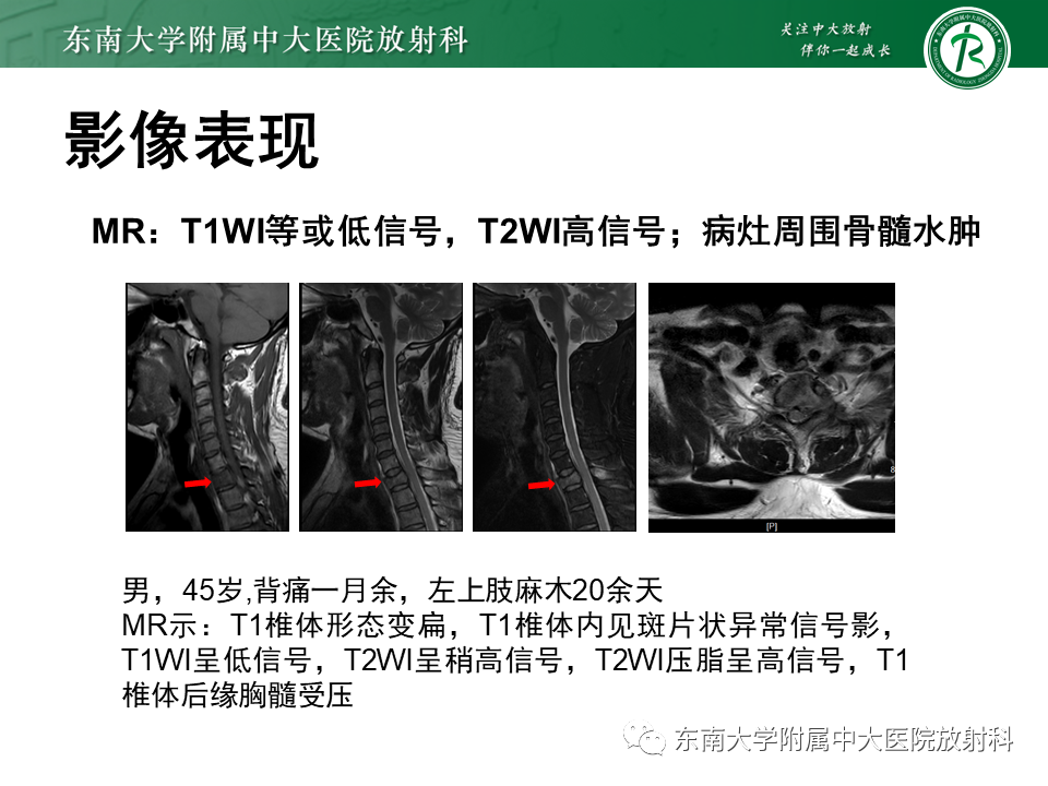 影像PPT - 【病例】脊柱朗格汉斯组织细胞增生症1例CT-11