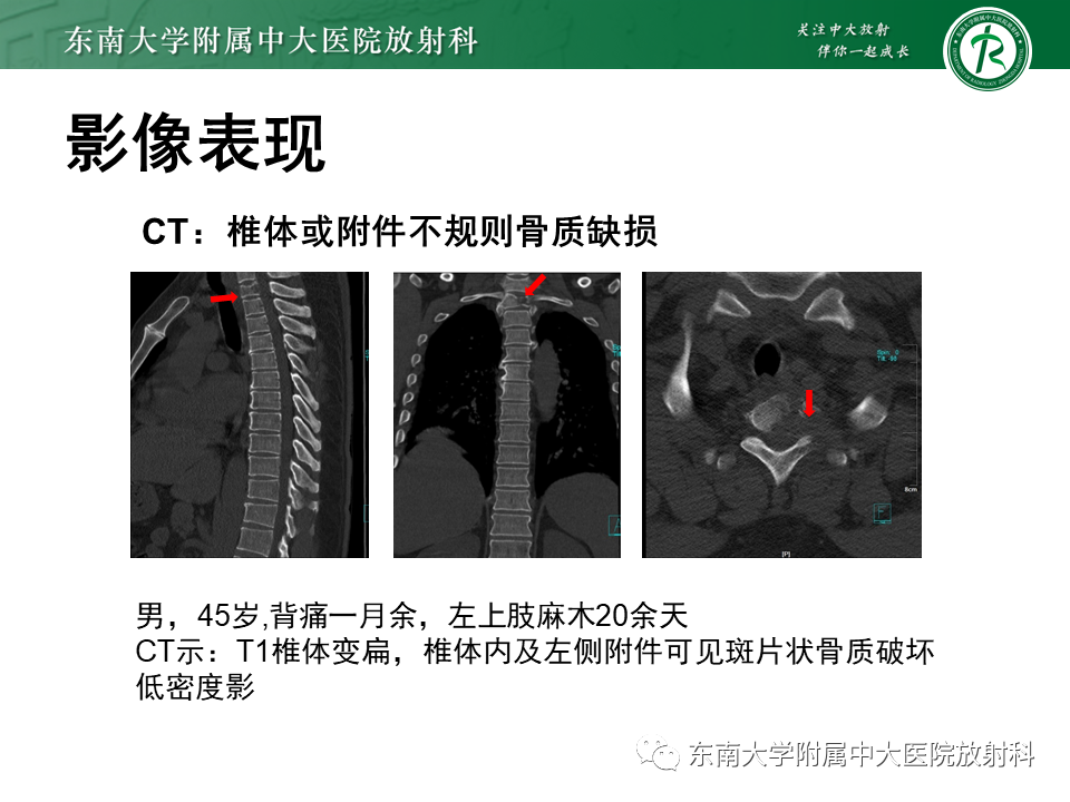 影像PPT - 【病例】脊柱朗格汉斯组织细胞增生症1例CT-10