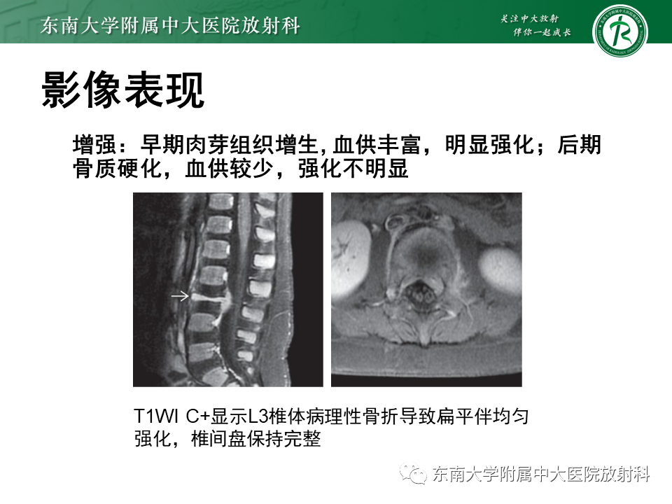 影像PPT - 【病例】脊柱朗格汉斯组织细胞增生症1例CT-12