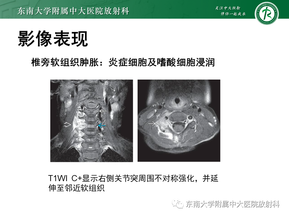 影像PPT - 【病例】脊柱朗格汉斯组织细胞增生症1例CT-13