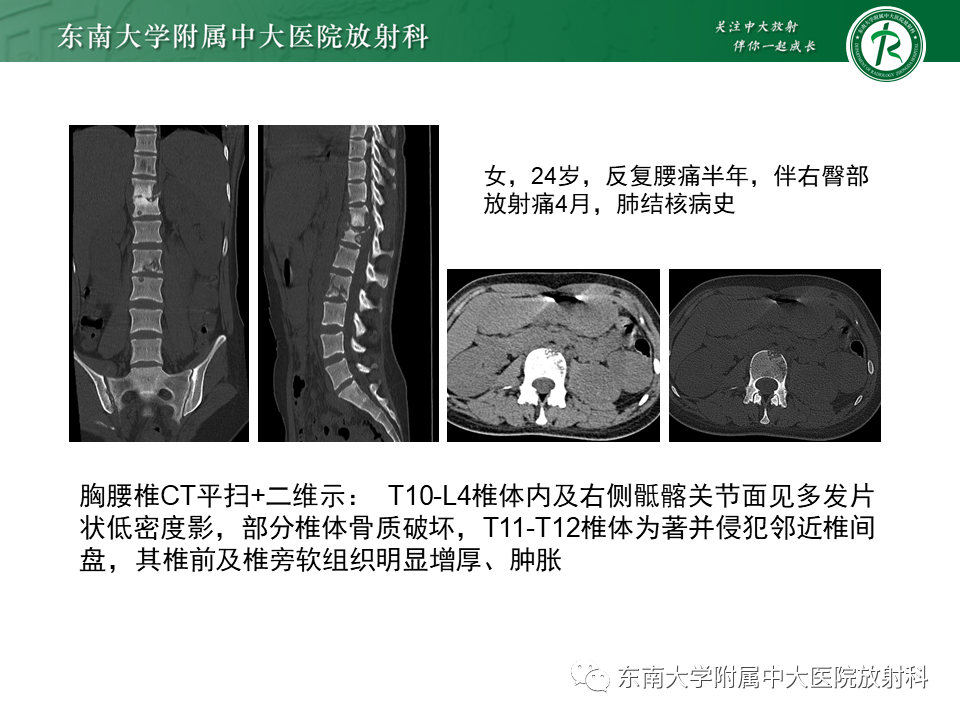 影像PPT - 【病例】脊柱朗格汉斯组织细胞增生症1例CT-19