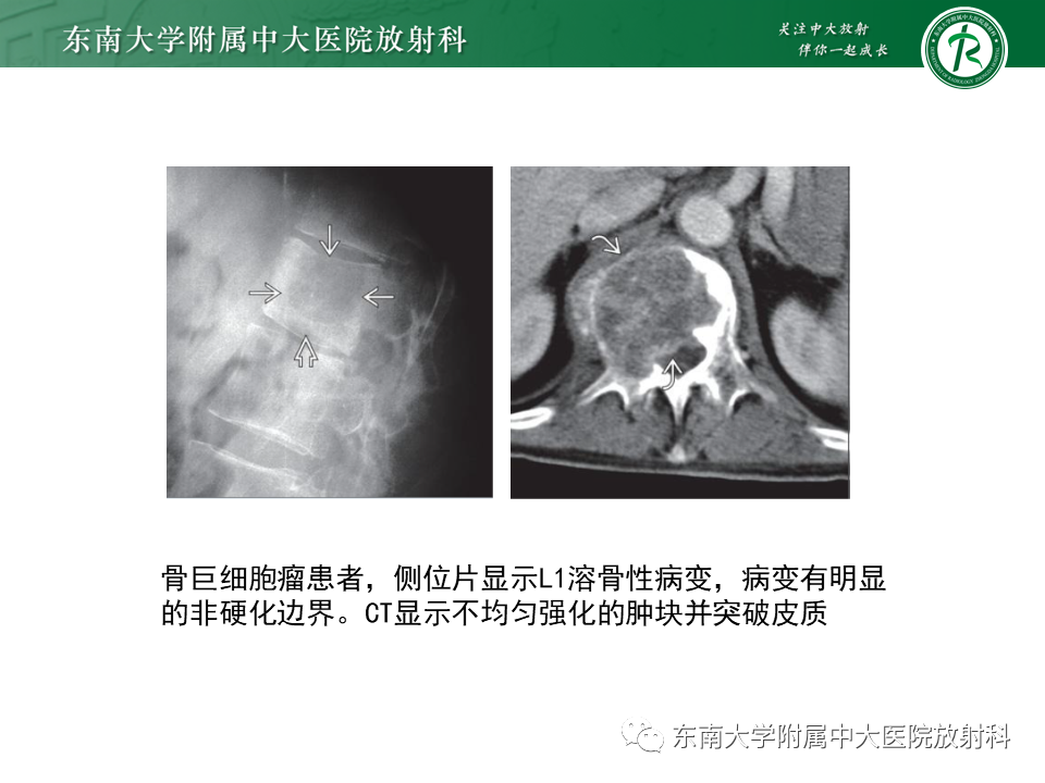 影像PPT - 【病例】脊柱朗格汉斯组织细胞增生症1例CT-23