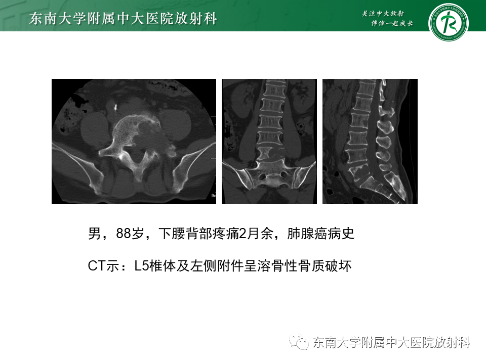 影像PPT - 【病例】脊柱朗格汉斯组织细胞增生症1例CT-25