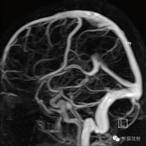 影像PPT - 脑膜解剖及其血供、硬脑膜静脉窦、MRV-9 影像PPT - 脑膜解剖及其血供、硬脑膜静脉窦、MRV-9