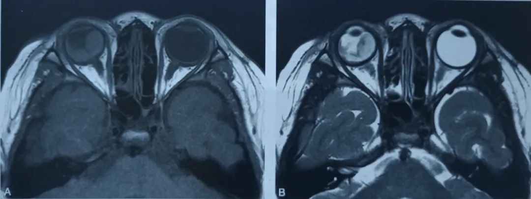 影像PPT - 外层渗出性视网膜病变影像诊断-1 影像PPT - 外层渗出性视网膜病变影像诊断-1