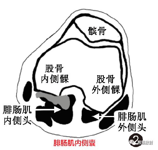 影像PPT - 膝关节滑囊解剖分组、示意图-2 影像PPT - 膝关节滑囊解剖分组、示意图-2