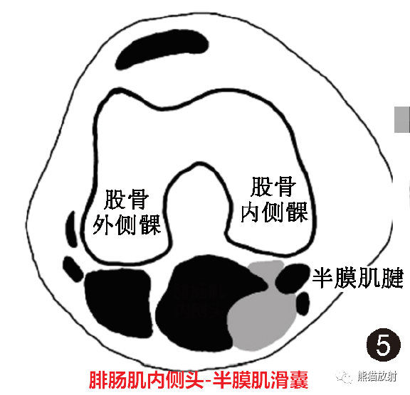 影像PPT - 膝关节滑囊解剖分组、示意图-5 影像PPT - 膝关节滑囊解剖分组、示意图-5