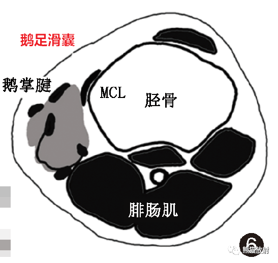 影像PPT - 膝关节滑囊解剖分组、示意图-6 影像PPT - 膝关节滑囊解剖分组、示意图-6